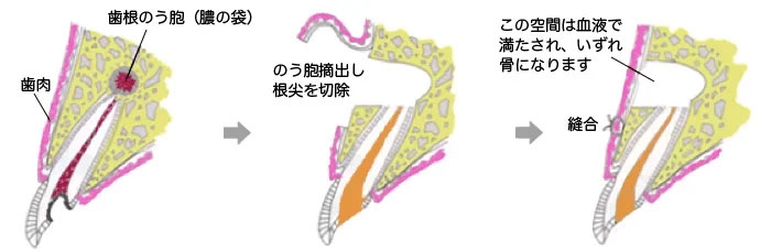 歯根端切除